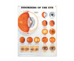 DISORDERS OF EYE ANATOMICAL CHART