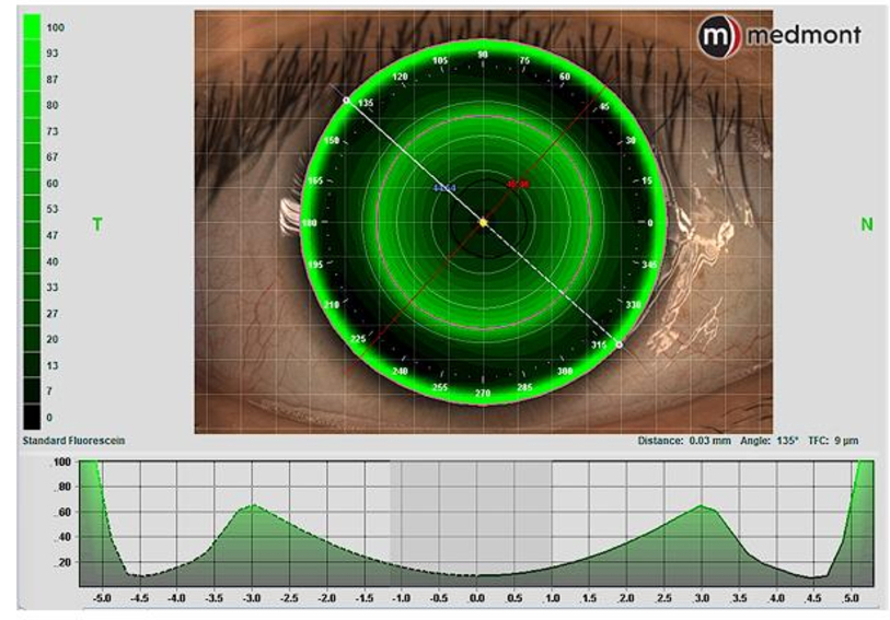 Corneal topography scan in Medmont Studio
